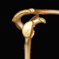 Cirurgia de Latarjet - Figura 1 - Lesão óssea
