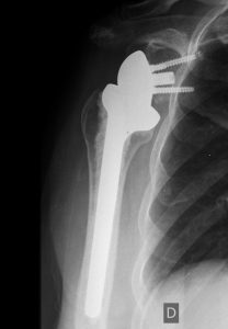 Artroplastia Reversa